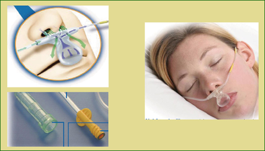 Figure 1. Smart CapnoLine® H Plus EtCO2 Sampling Line Courtesy of Oridion