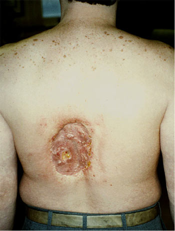 Figure 2: Deep tissue necrosis 18 to 21 months following FGI. The peak skin dose was estimated to be > 20 Gy in this case. Source: United States Food and Drug Administration. 